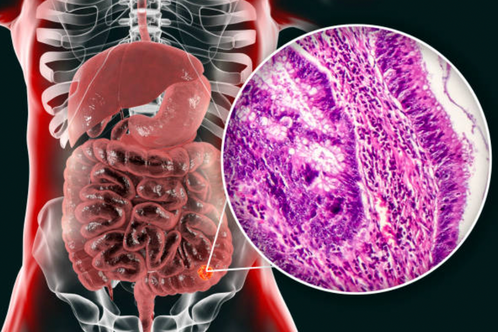 Bowel most cancers leap forward as 'game-changing' remedy shrinks tumours in majority of sufferers