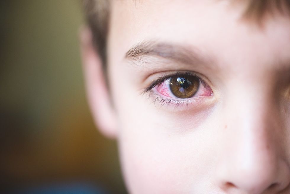 Child with conjunctivitis