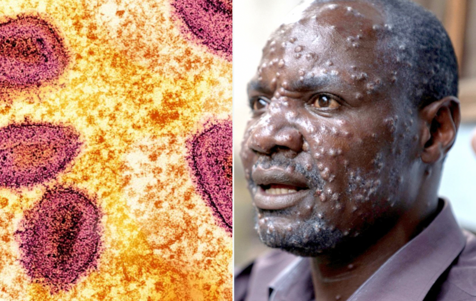 Composite image of mpox virus particles and a man with mpox blisters on his face 