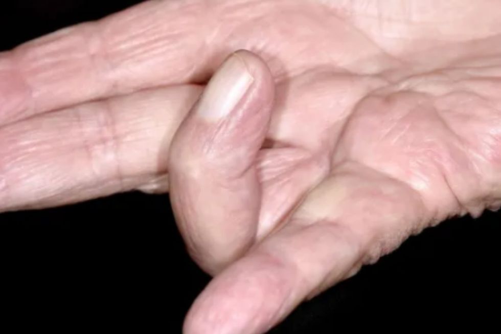 Dupuytren's contracture