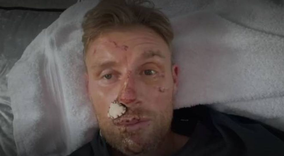 Freddie Flintoff shared new footage of his facial injuries on BBC One