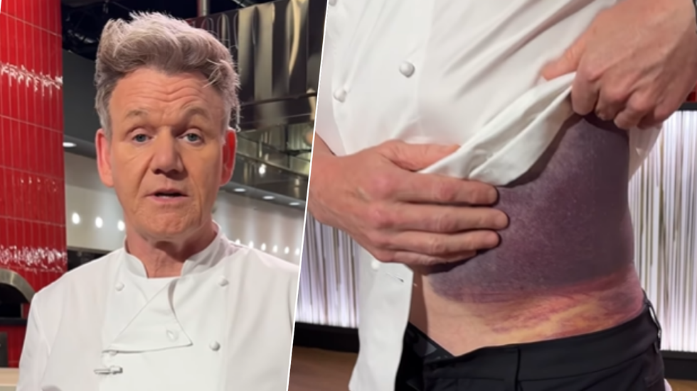 Gordon Ramsay/Bruise