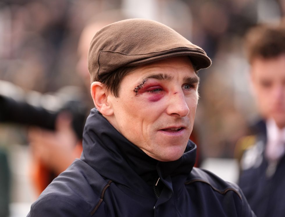 Horse racing star shocks fans by sporting black eye at Cheltenham ...