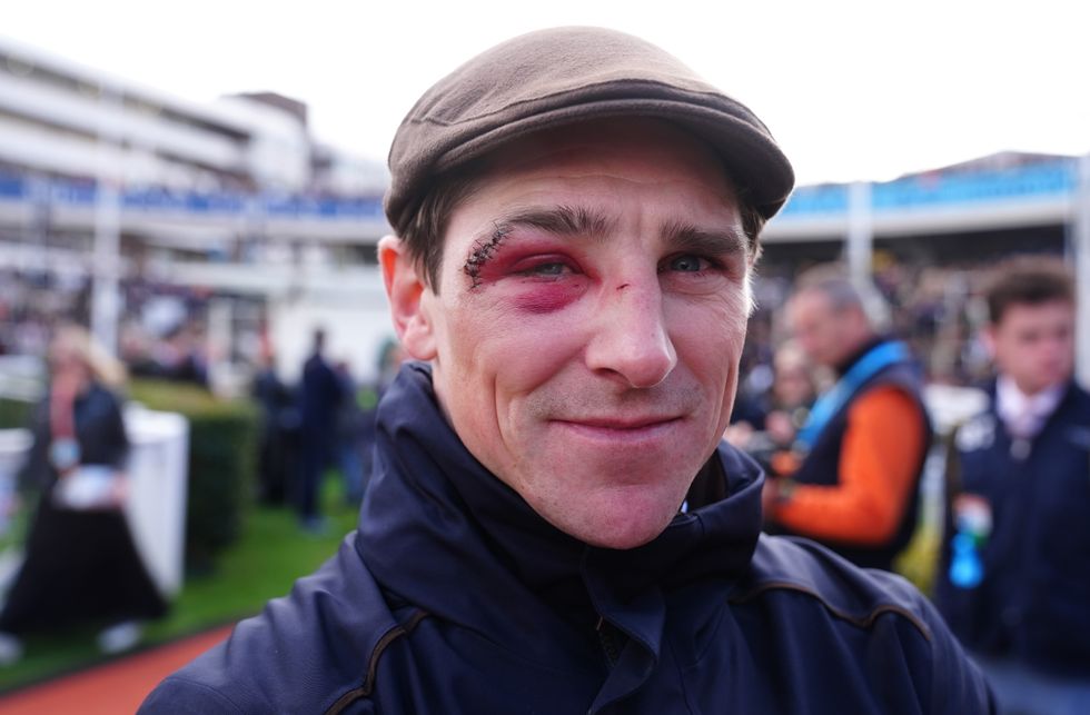 Horse racing star shocks fans by sporting black eye at Cheltenham ...