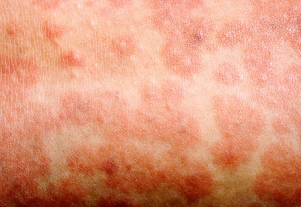 Measles rash