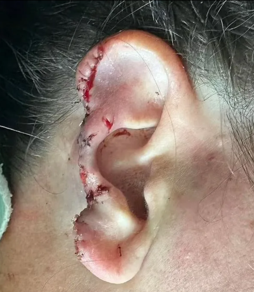 Royce's stitched up ear