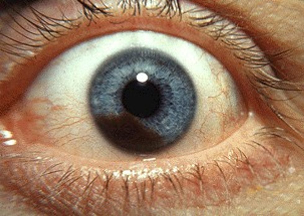 u200bAn example of Iris melanoma