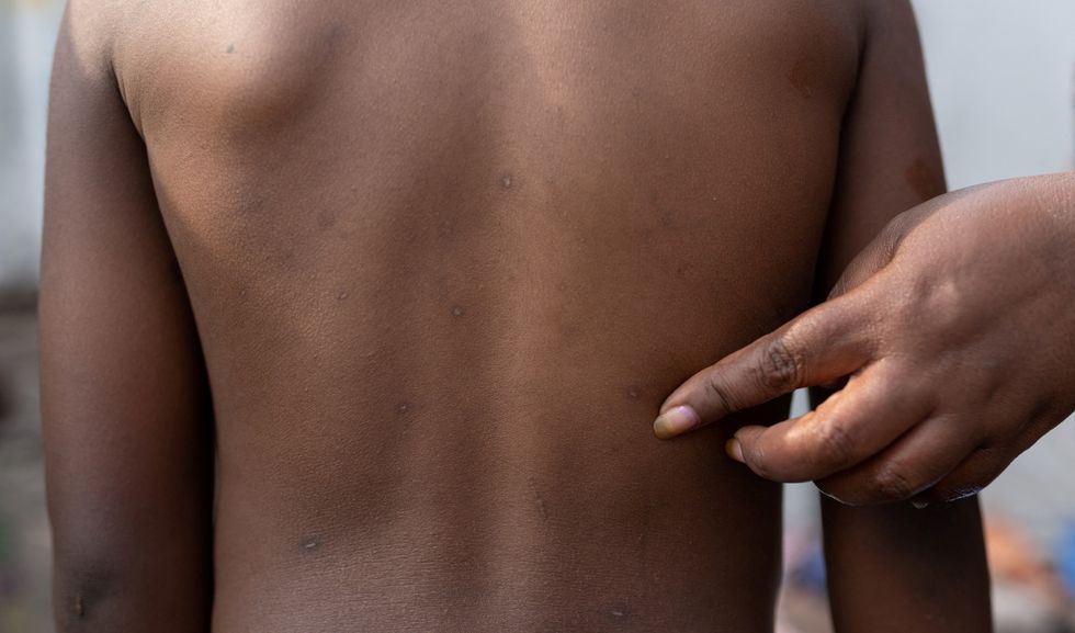 Zawadi Bwira Bakulu, 35, shows the rash marks on her son Christevie Lukeka who recovered from Mpox in Nyiragongo territory near Goma